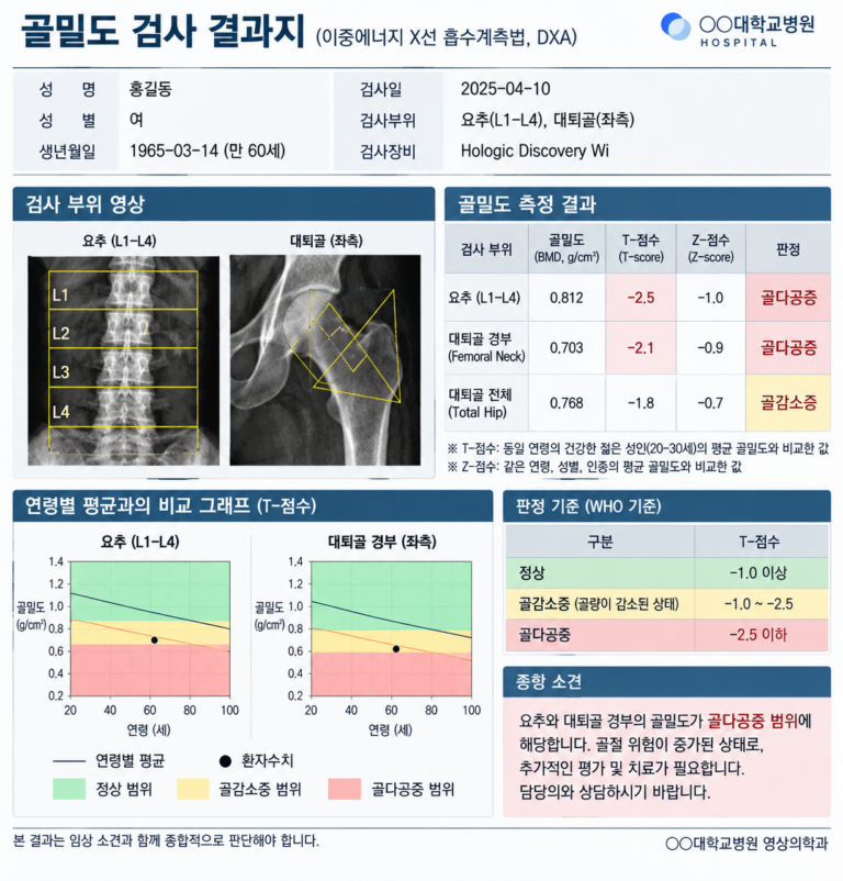골밀도 검사 결과 보는 법, T점수 -2.5는 무슨 뜻일까?